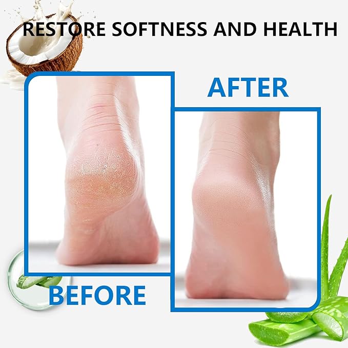 Urea Foot Cream, 42 Percent Urea Cream plus 2% Salicylic Acid Cracked Heel Repair Cream for Feet and Hand Foot Cream for Callus Remover & Nourishes Soften for Hand Foot And Body Care, 100g