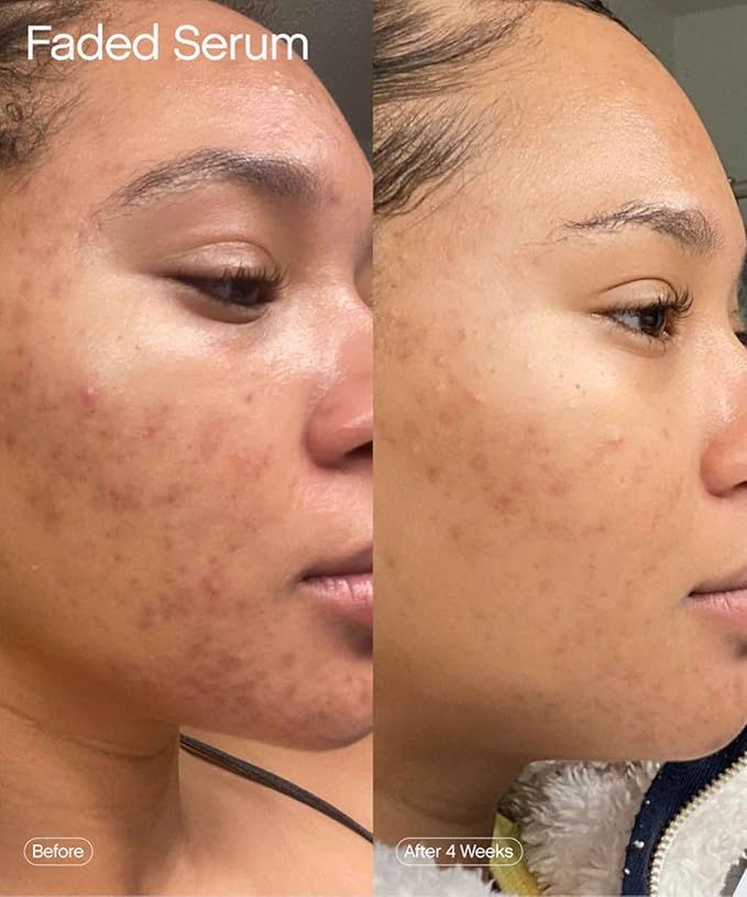 Topicals Faded Brightening and Clearing Serum | Reduces Discoloration, Post-Blemish Marks, Scars and Spots | Contains Kojic Acid and Niacinamide | Dermatologist-tested, Vegan, Cruelty-Free (1.7 Fl Oz)