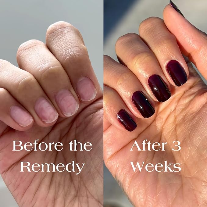 Botanist Nail Rescue Kit | Nail Strengthening Polish + Growth Serum | Grow and Strengthen Damaged Nails | Non-Toxic, 84% Plant Based, 21-Free & Vegan (Cherry Mocha)