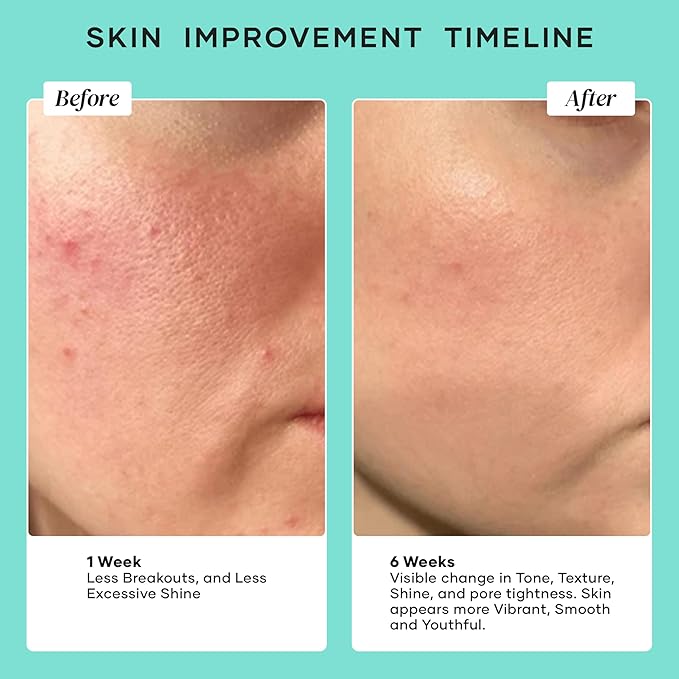 DERMAdoctor Pore Minimizer Niacinamide Serum for Face | Vitamin B3 Niacinamide Oil Control Pore Minimizer for Visible pores, Blackheads, Uneven Skin Tone, Redness, Oily Skin - Dermatologist Formulated