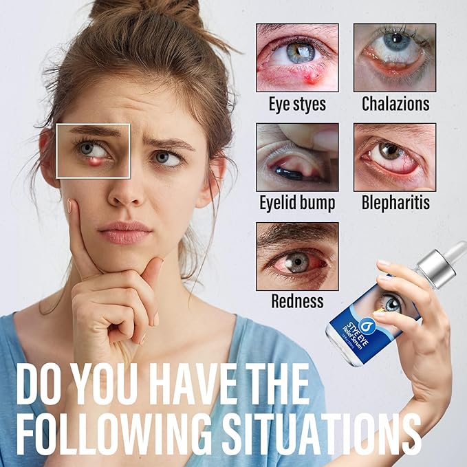 Stye Eye Drops, Stye Eye Treatment, Eye Stye Relief Serum, Non-Irritating Formula with Hippophae Rhamnoides Fruit Oil & Avo-cado Oil, Target Chalazions & Blepharitis (1 Fl. OZ)