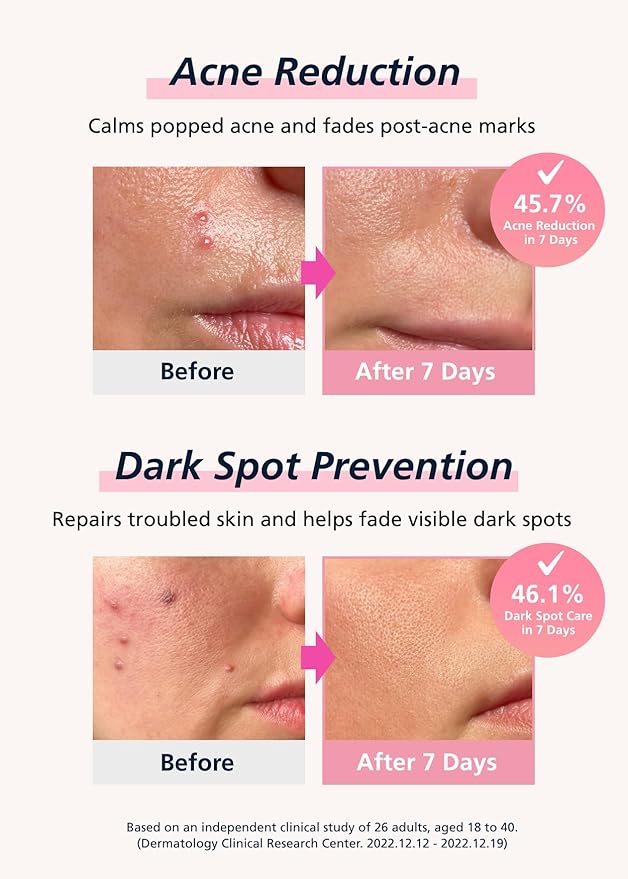 EasyDerm Real Calming Pimple Patches, Clear | Niacinamide, Hyaluronic Acid, EGF Acne Dark Spot Care, K-beauty | 6 counts, Micro Point length : 285μm