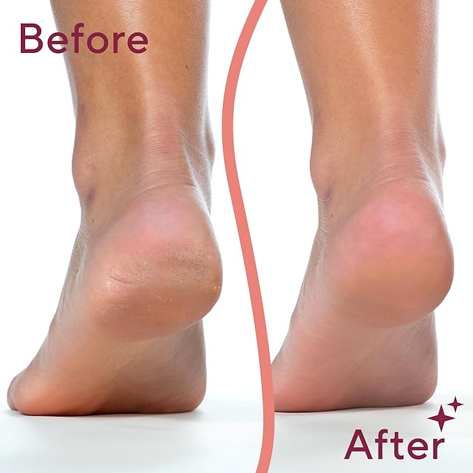 Finishing Touch Flawless Pedi Electronic Tool File and Callus Remover, Pedicure-New Version (Amazon Exclusive)