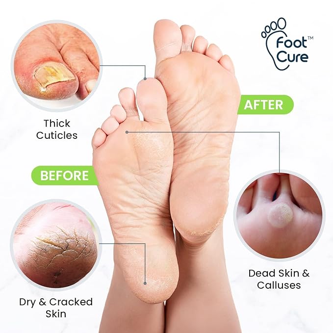 FOOT CURE Exfoliator & Callus Remover Pedicure Set – Care Kit Includes File for Dead Skin, Tea Tree Oil Soak Salts, Urea Cream 40 Percent Removal Gel Made in USA, Ivory, 4 Piece