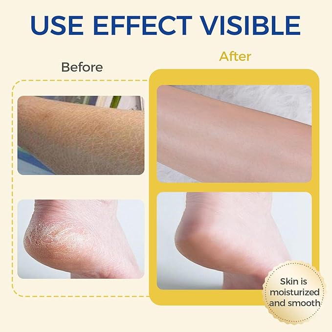 Feet Cream with 60% Urea+2% Salicylic Acid, Anti-Cracking Moisturizer Foot Cream, Foot Lotion Stick for Heels, Dry Hands & Rough Knees, Exfoliating Dead Skin, Repairs and Hydrates Feet, 2 PCS