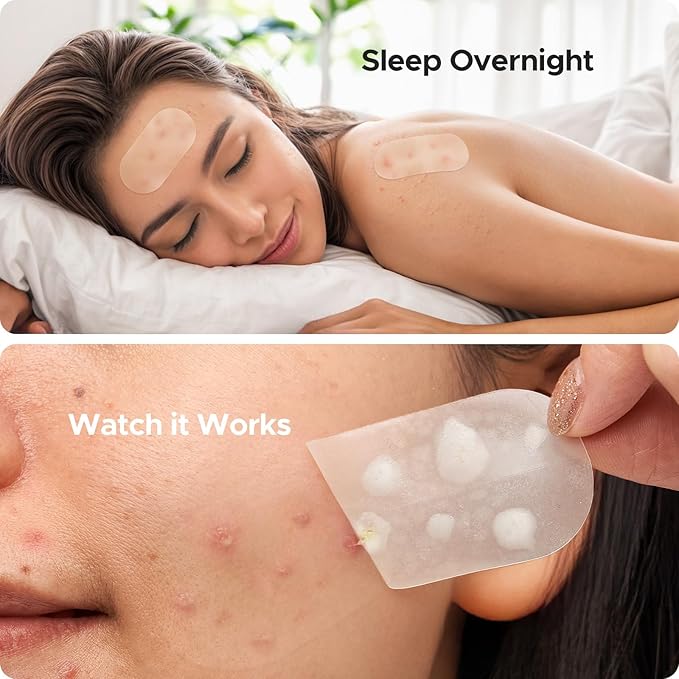 TKTK Large Pimple Patches for Face, 60 x 30 mm XL Acne Patches, Big Hydrocolloid Bandages for Body, Back, Forehead, Chin, Neck Blemish Zit Breakouts (Oval, Square, Dot 5 Sizes 265 Count)