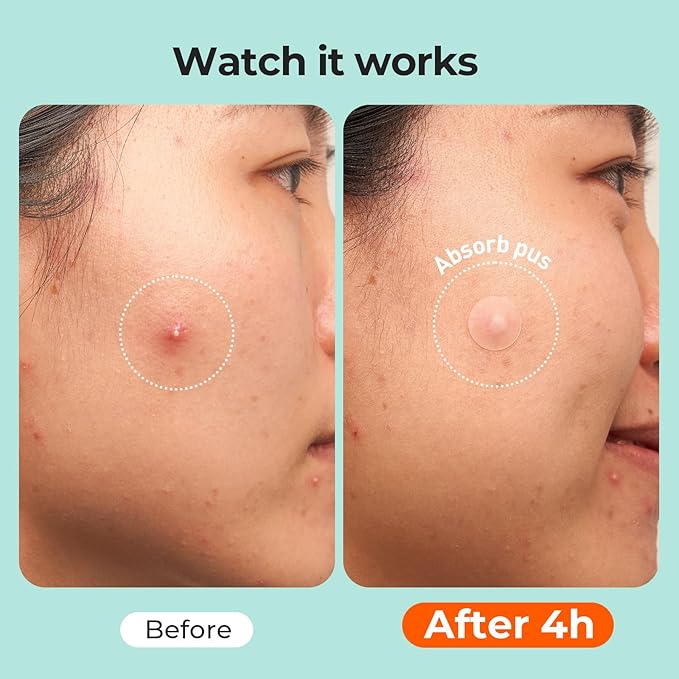TKTK 443 Count Pimple Patches for Face, Hydrocolloid Acne Patch Bulk, Acne Stickers for Covering Cheeks, Forehead, Chin Blemishes Zit Breakouts for All Skin Types (Dots, Strip, Contoured 5 Sizes)