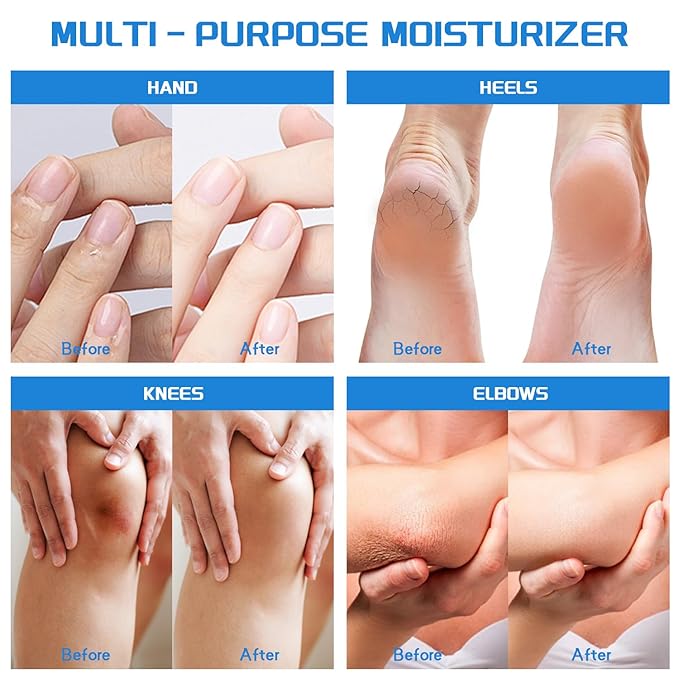 Urea Cream 40 percent for Feet Maximum Strength + 2% Salicylic Acid, Exfoliating Dead Skin & Soften Crack Foot for Extremely Dry Skin Body Lotion, Urea 40% Cream Enriched Skin Moisturizer, 5.3 oz（40%）