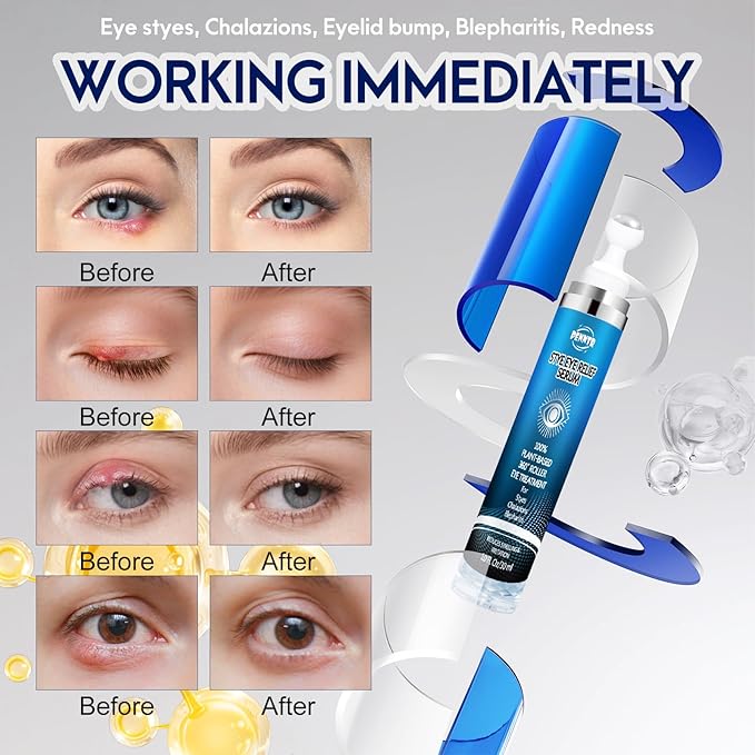 Stye Eye Treatment, Eye Serum for Stye, Chalazions & Blepharitis Roller Serum, Natural and Plant-based Formula (1 Fl Oz)