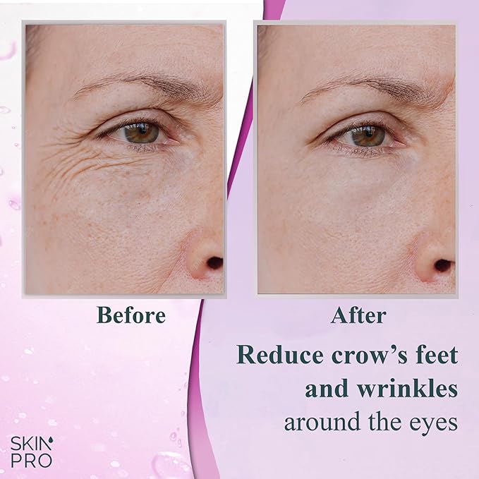 SkinPro Elite Serum 10 - Anti Aging Eye Serum for Dark Circles and Puffiness - Under Eye Brightener, Wrinkles, Eye Bag Remover with Advanced Formulation of Hyaluronic Acid, Argireline and Peptides