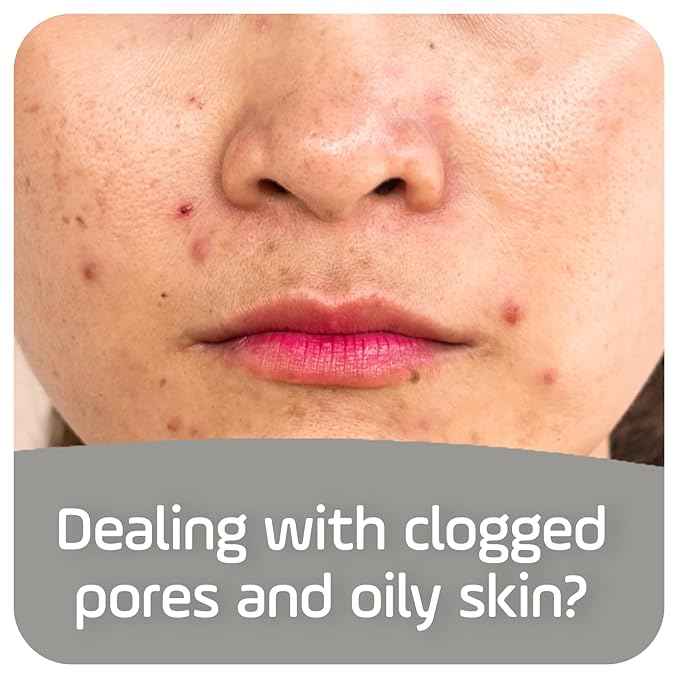 Asepxia Cleansing Bar Baking Soda, Multipack: Deep Skin Cleansing, Acne Fighting with 2% Salicylic Acid, Removes Oil and Dirt, Prevents Imperfections, Suitable for All Skin Types - 4 Oz, 5 Count