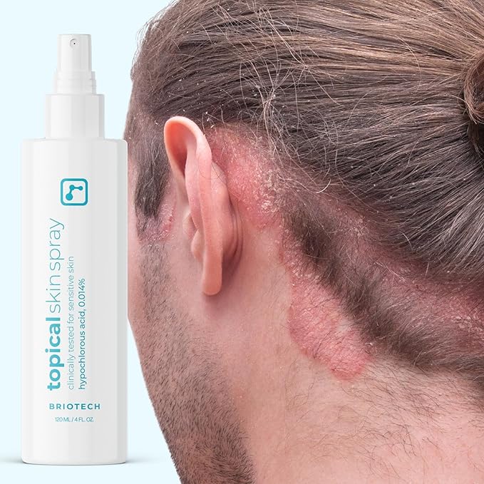 BRIOTECH Topical Skin Spray, Hypochlorous Acid Spray for Sensitive Skin, HOCl Facial Mist, Full Body Support Against Irritation, Calm Redness, Soothe Foot & Scalp, 8 oz (1 Pack)