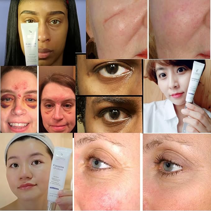 Anacis Vitamin K1 Oxiderm Cream Minimizing Appearance of Old and New Scars, Dark Eye Circles, Bruises, Varicose Veins, Purpura and Redness 1.01Oz