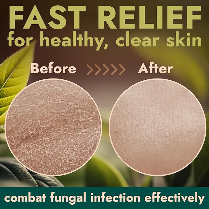 Antifungal Body Wash with Tea Tree Oil | Antifungal Soap for Back Acne,Treats Ringworm, Eczema & Jock Itch | Antifungal Body Soap For Men And Women | Includes Silicon Scrubber (16.9 oz)