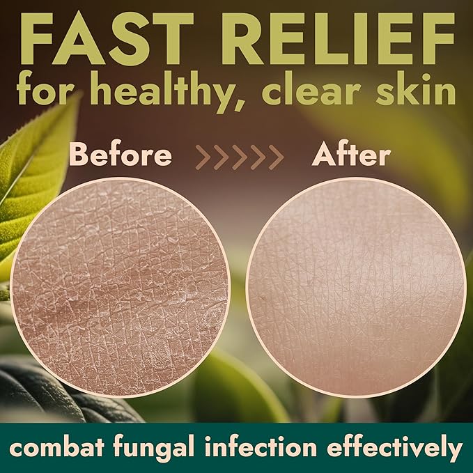 Terramed Just Think Comfort Antifungal Body Wash with Tea Tree Oil | Antifungal Soap Treats Ringworm, Back Acne, Eczema & Jock Itch | Antifungal Body Soap For Men And Women (16.9 oz)