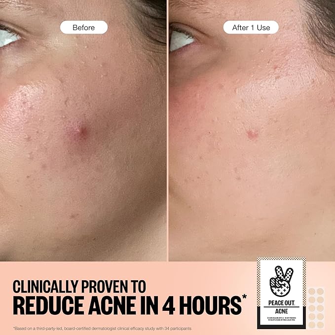 PEACE OUT Acne Healing Dots Hydrocolloid Pimple Patches, Acne Spot Patches with Salicylic Acid, Retinol, and Aloe Vera for Blemishes and Breakouts, 60 Count
