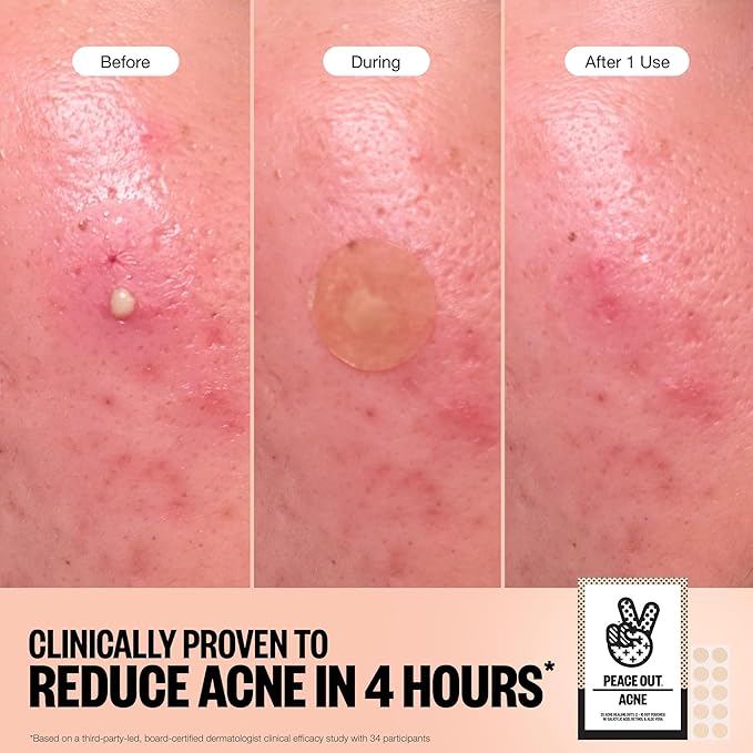 PEACE OUT Acne Healing Dots Hydrocolloid Pimple Patches, Acne Spot Patches with Salicylic Acid, Retinol, and Aloe Vera for Blemishes and Breakouts, 60 Count
