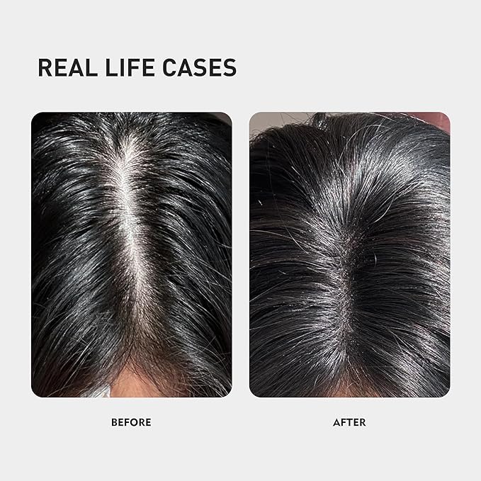 0.5% KINTOR KX-826 Hair Growth Spray,Oil Control Strengthen Hair,Hair Regrowth Products for Women&Men,Basic,360ml
