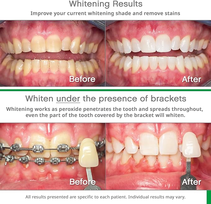 Opalescence Go 15- Prefilled Teeth Whitening Trays - 15% Hydrogen Peroxide - (10 Treatments) Made by Ultradent Products. Teeth Whitening Kit -Mint - 5194-1