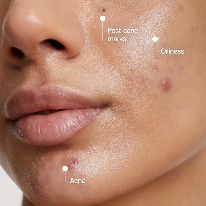 Neutrogena Evenly Clear Acne Cleansing Face Mask with 3.5% Benzoyl Peroxide Treats Breakouts & Bentonite Clay, Purifying Clay Mask Absorbs Oil to Visibly Improve the look of Skin, 4.2 fl. oz