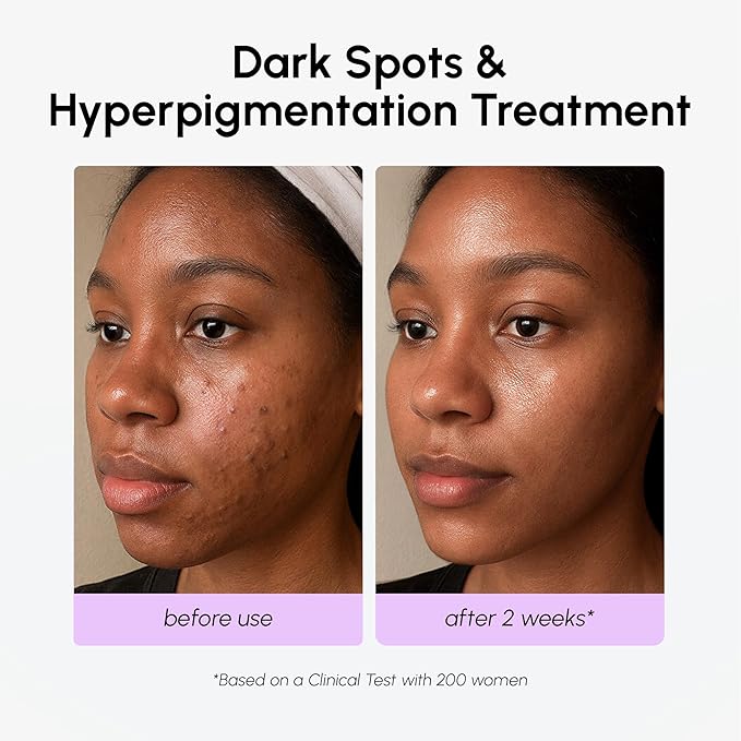 MAREE 20% Tranexamic Acid Serum Complex with Niacinamide & Vitamin C – Serum for Face & Body Dark Spot Corrector – Age Spots Hyperpigmentation Care Remover – Brightening Acido Tranexamico para Manchas
