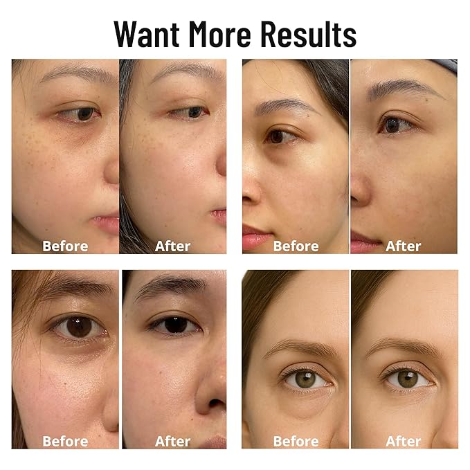 Caffeine 5% + Bakuchiol Eye Serum for Dark Circles, Puffiness Eyes with Argireline & Copper Peptides (GHK-Cu) – Roll-on Under Eye Serum, Anti-Aging Wrinkle Care for Fine Lines– 20ml