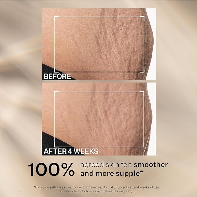 StriVectin SD Advanced Plus Intensive Moisturizer for Wrinkles and Stretchmarks, For Face and Body, Collagen Boosting with Peptides and Hyaluronic Acid