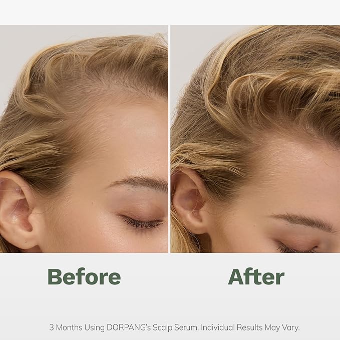 Scalp Serum for Thinning Hair in Men & Women, 60ml (2.0 Fl Oz) Clinically Tested Vegan Formula with Peptides & Rosemary Oil, Improves Hair Density & Scalp Health, Non-Greasy No-Rinse