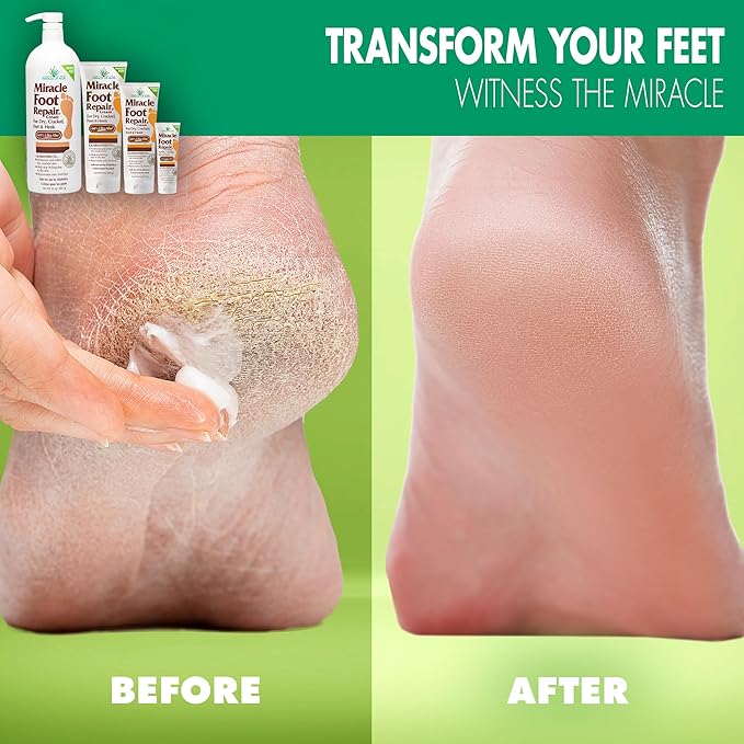 Miracle Foot Repair Cream (8 oz & 1 oz) Repairs Dry Cracked Heels and Feet, 60% Pure UltraAloe Moisturizes, Softens, and Repairs