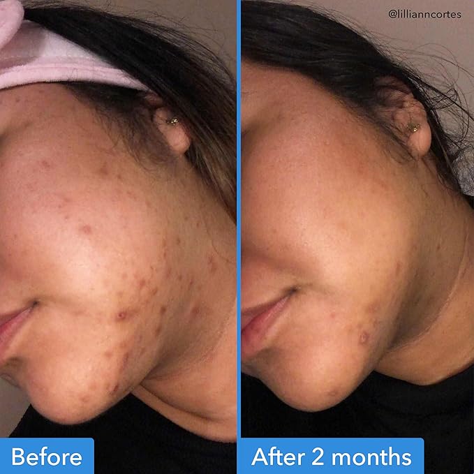 Good Molecules Discoloration Correcting Serum - Tranexamic Acid and Niacinamide Serum to Target Dark Spots and Hyperpigmentation - Skin Care for Face