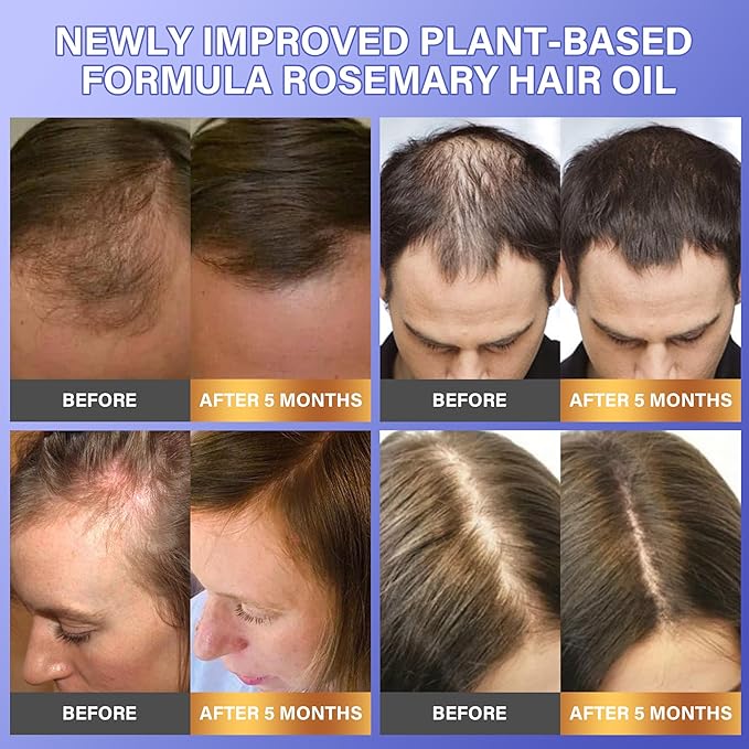 Rosemary Hair Growth Serum - Hair Scalp Oil with Organic Rosemary Essential Oil, Upgraded Plant-Based Formula to Invigorate Follicles Strengthen Roots and Reduce Loss & Bald Patches for Men & Women