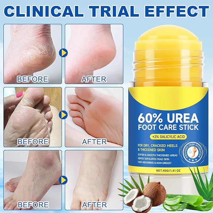 60% Urea Foot Cream Stick with 2% Salicylic Acid, Urea Foot Care Stick & Cream - Moisturizer for Dry, Cracked Skin on Feet, Knees, Elbows & Hands - Hydrates & Repairs Rough Skin 2Pack