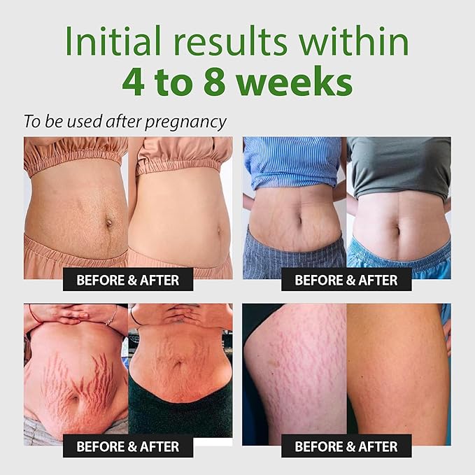 Abera Ovela Maternity Stretch Mark Cream