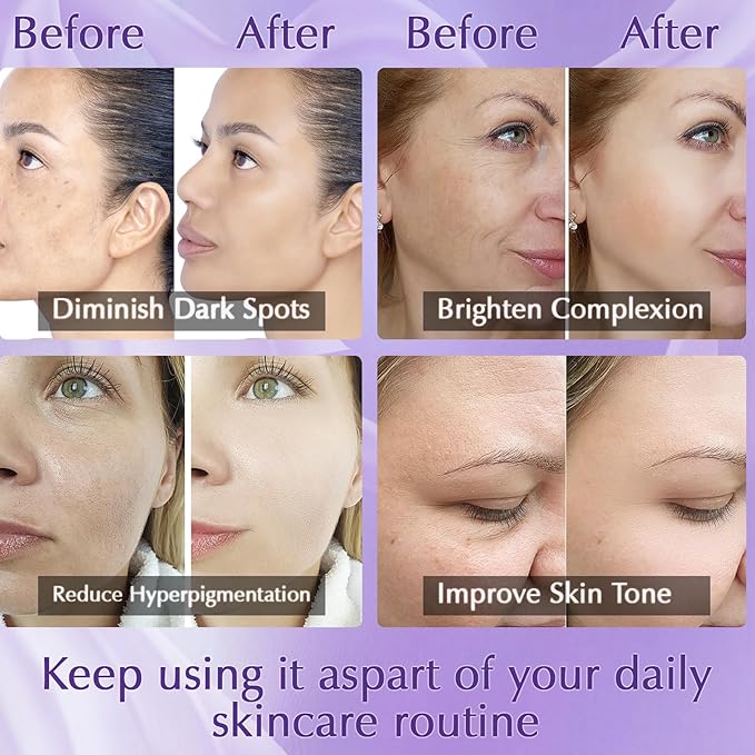 Dark Spot Remover for Face and Body, Dark Spot Corrector, Rapid Tone Repair Retinol Cream, Melasma Treatment with Vitamin C, Upgraded Skin Care Cream for Women Men