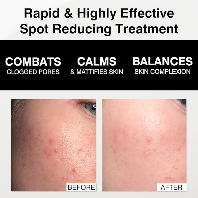Dr Sebagh Complete Breakout Solution for Oily Skin - 1 x Balancing Cream (1.7 fl oz.) & 5 x Spot Treatment Powders (0.07 oz.) | Award-Winning | Rapid & Effective Results for Blemish-Prone or Oily Skin